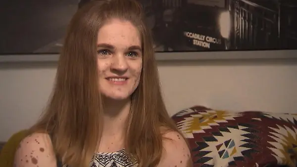 Wie Marika ihre Pigmentstörung zu ihrer Stärke machte