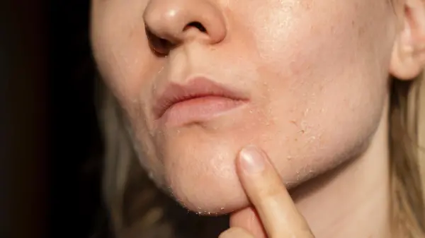 The woman skin flakes off at the mouth. Dry skin. Face skin irritation after peeling, after cold windy weather. Dark background, view by profile. She is showing the problem with the finger.