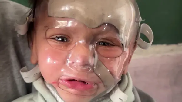 Seine Haut heilt nicht mehr! Mohammed (1) überlebt nur mit dieser Spezialmaske